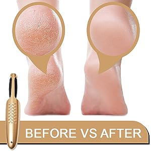 Foot File Callus Cracked Heels Hard Dead Skin Remover Feet Filer Care – DNA  MERCHANDISE